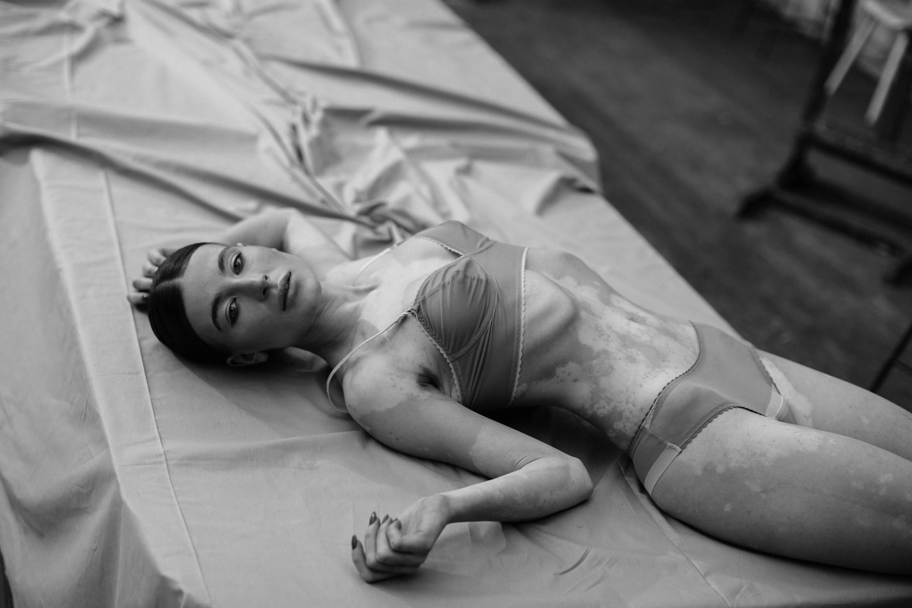 A black and white portrait of a woman with vitiligo lying on a studio surface, showcasing beauty and strength.